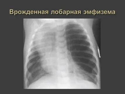 Врожденная долевая эмфизема