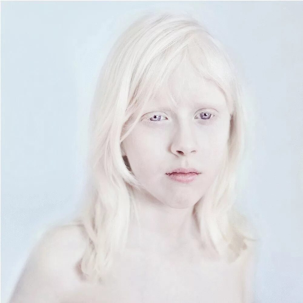 Страдающий альбинизмом. Кожно глазной альбинизм. Альбинизм Эстетика.