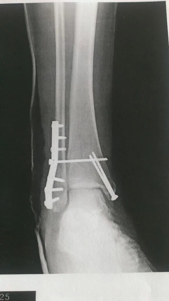 Перелом со смещением нужна операция. Остеосинтез трехлодыжечный перелом. Остеосинтез двухлодыжечный перелом. Внутрикостный остеосинтез лодыжки. Остеосинтез наружной лодыжки пластиной.