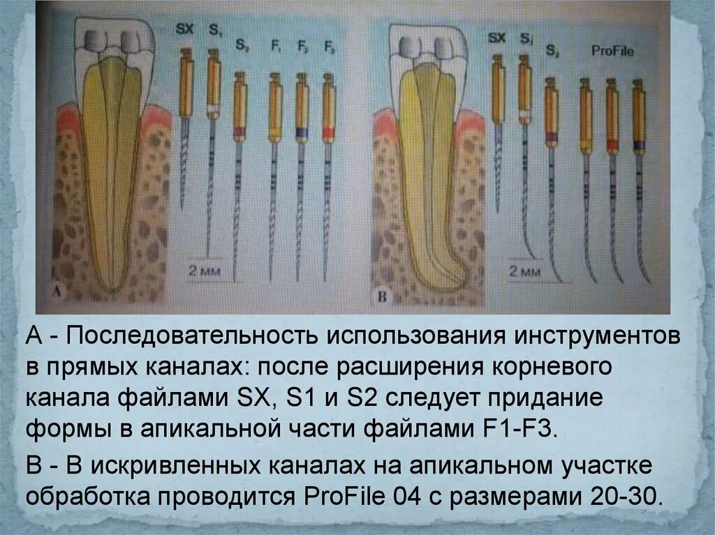 Определение корневых каналов. Методики расширения корневых каналов. Апикалный части корговего канала. Порядок расширения корневого канала. Инструменты для расширения корневых каналов.