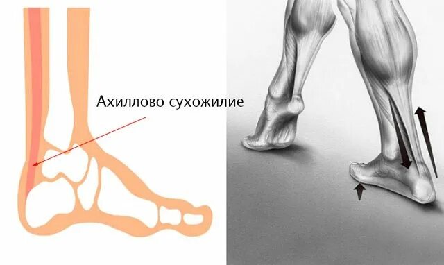 Где находится сухожилие. Пластика ахиллова сухожилия. ахиллово сухожилие анатомия. повреждение ахиллова сухожилия. ахиллово сухожилие тендинит.