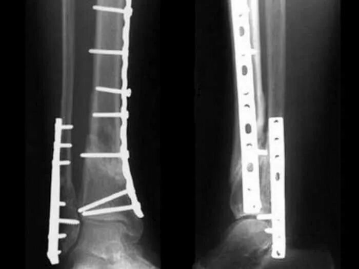 Остеосинтез операция пластины. Накостный остеосинтез голени рентген. Остеосинтез костей голени операция. Остеосинтез костей голени рентген. Аппарат Илизарова экстрамедуллярный остеосинтез.