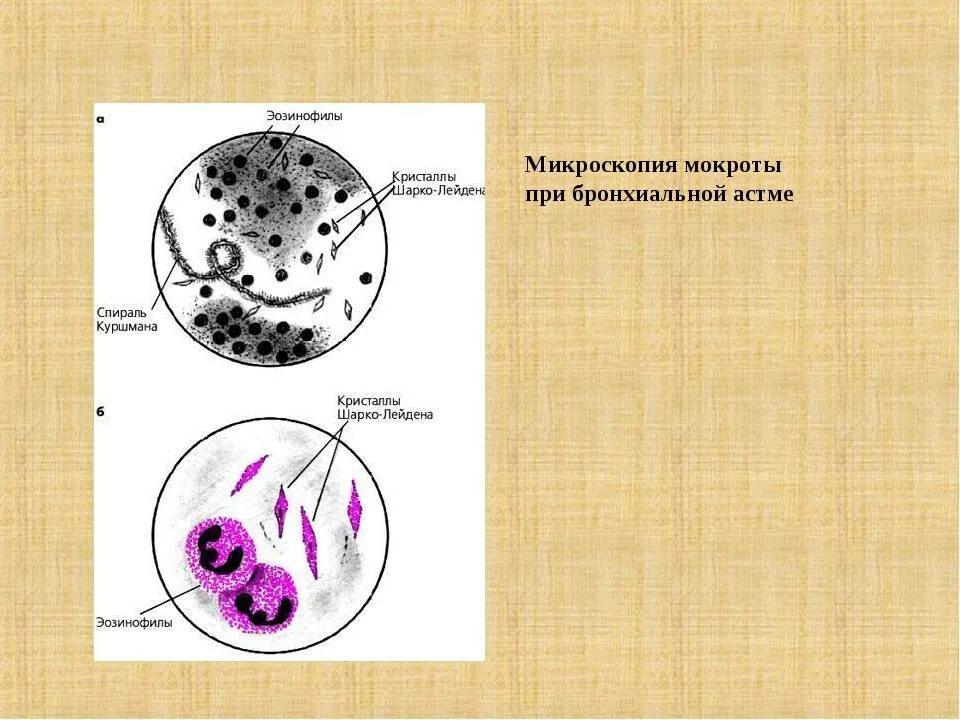 Образование мокроты. Спирали Куршмана и Кристаллы Шарко-Лейдена. Спирали Куршмана и Кристаллы Шарко-Лейдена в мокроте. Спирали Куршмана, Кристаллы Шарко-Лейдена, эозинофилы. Спирали Шарко Лейдена в мокроте.