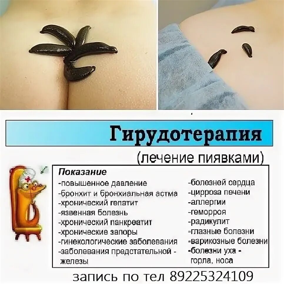 Выразить гирудотерапия эффект. Гирудотерапия показания. лечебный эффект гирудотерапии. понятие гирудотерапии.