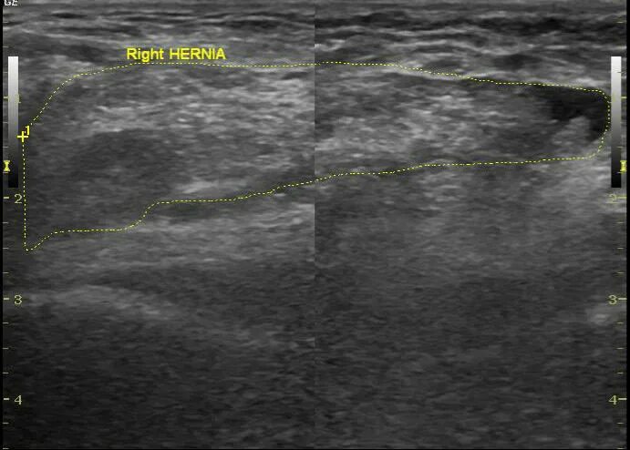Пахово-мошоночная грыжа на УЗИ. Пахово-мошоночная грыжа на УЗИ протокол. Паховая грыжа анатомия УЗИ. Можно увидеть грыжу на узи