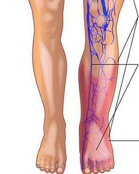 Карта вен нижних конечностей. Флебит тромбофлебит флеботромбоз. Тромбофлебит вены голени. Тромбоз поверхностных вен голени. Илеофеморальный флеботромбоз клиника.