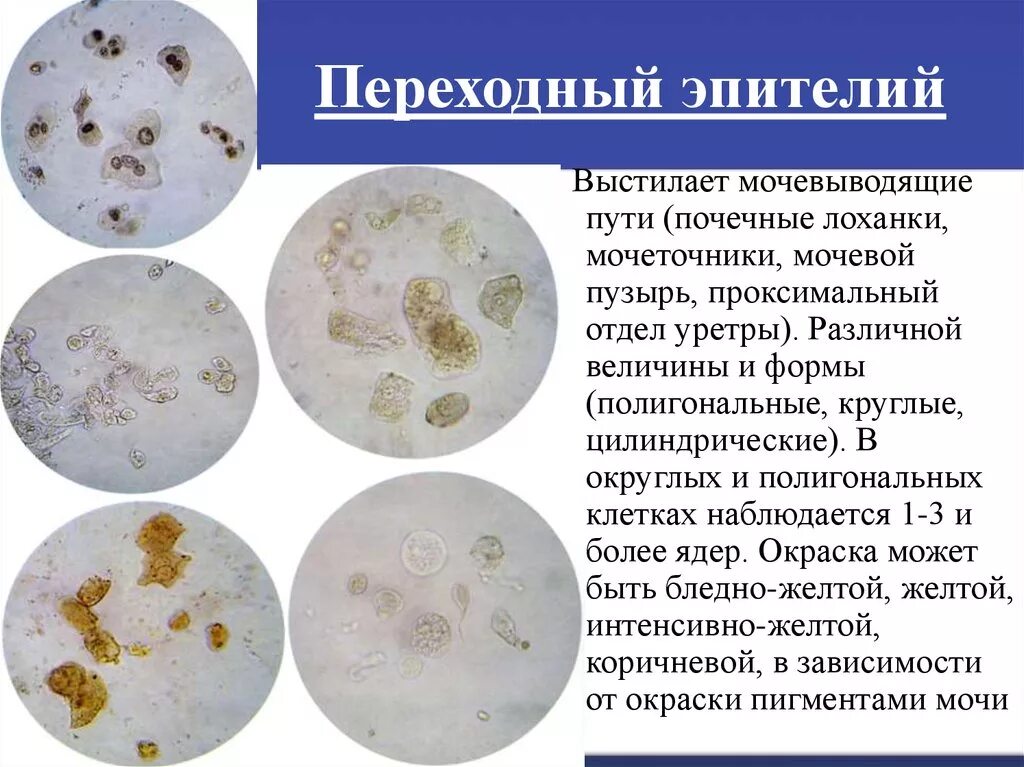 Микроскопия мочевого осадка. Почечный эпителий. Почечный эпителий в микроскопе. Микроскопия мочи клетки почечного эпителия. Почечный эпителий в моче под микроскопом.