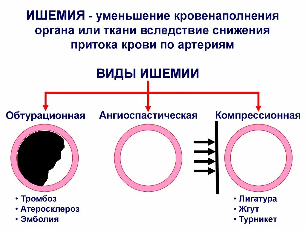 Ишемия крови. Виды ишемии. Причины ишемии. Условия возникновения ишемии.