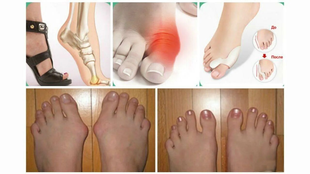 Воспаление хальгус вальгус. Почему растет шишка на большом пальце ноги. Почему растет шишка на большом пальце ноги. Вальгус начальная стадия. Вальгус деформация большого пальца стопы.