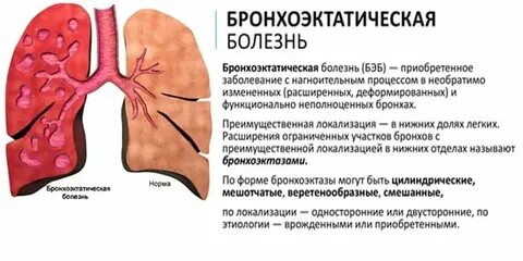 Бронхоэктаз это