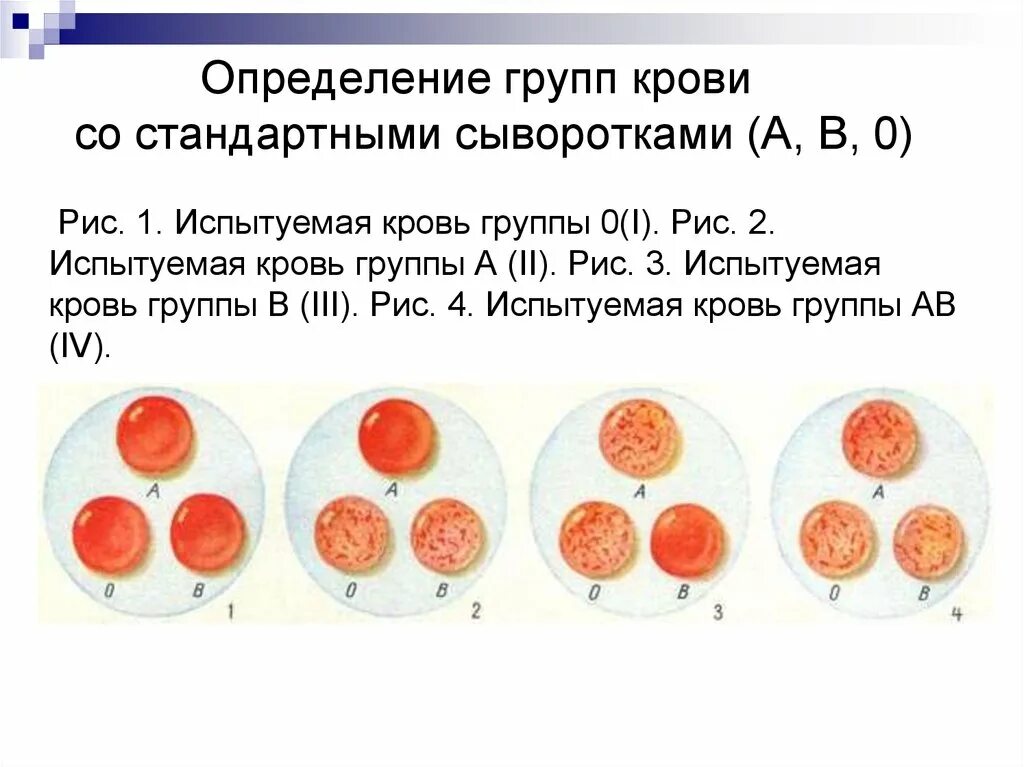 Результат определения группы крови. Реакции агглютинации для определения группы крови и резус-фактора. Определение групп крови по стандартным сывороткам. Методика определения группы крови с помощью стандартных сывороток. Определение группы крови с помощью стандартных сывороток.