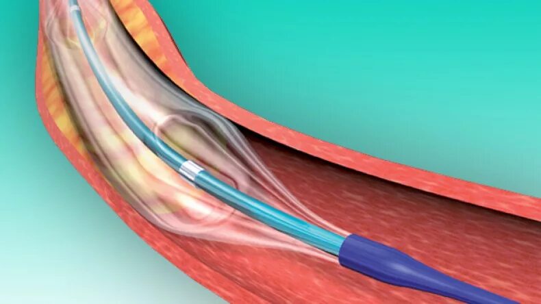 Ангиопластика цена. Эндоваскулярная баллонная вальвулопластика. ТРАНСЛЮМИНАЛЬНАЯ баллонная ангиопластика. Баллонная ангиопластика легочной артерии. Катетерная тромбэктомия.