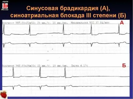 Брадикардии блокады
