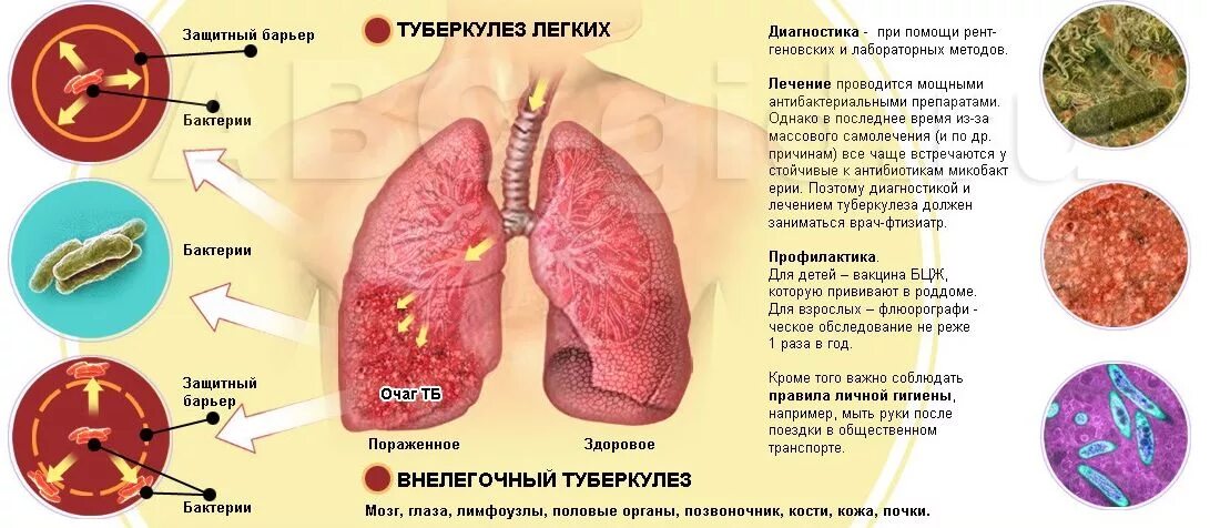 Опасные заболевания легких