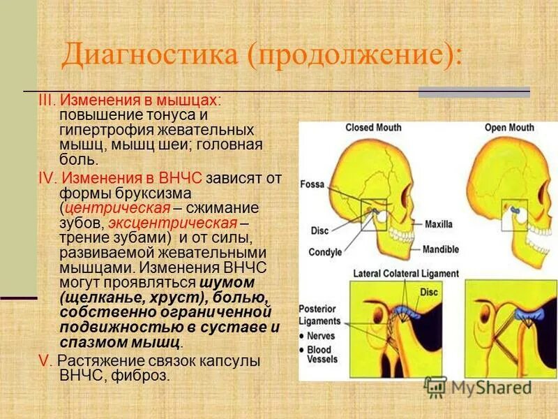 Нарушения работы мышц. Дисфункция височно-нижнечелюстного сустава (внчс). Укрепляется опорно-двигательный аппарат. Нарушения работы мышц. Нарушения работы мышц.