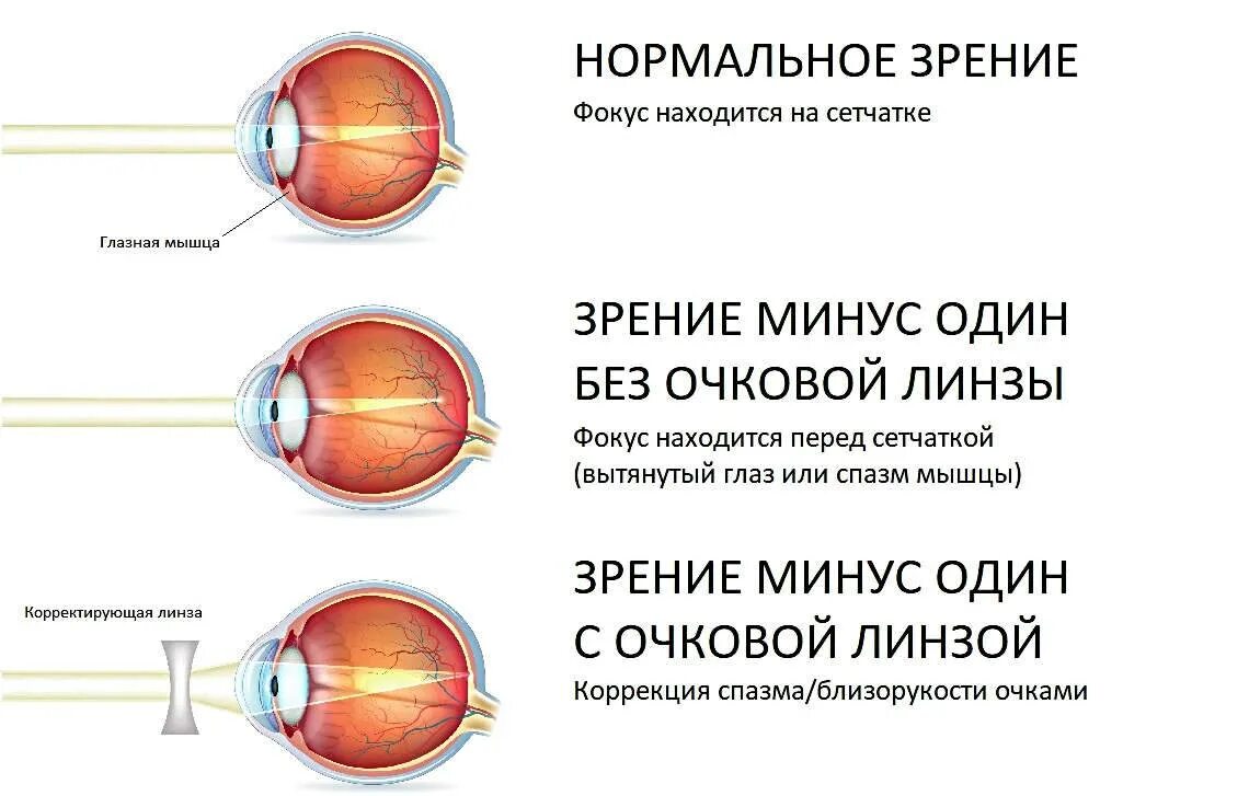 Как понять минус зрения. Близорукость (истинная и ложная формы патологии). минус 5 зрение как видят. как видит человек при зрении -1. как видит человек при зрении -5.