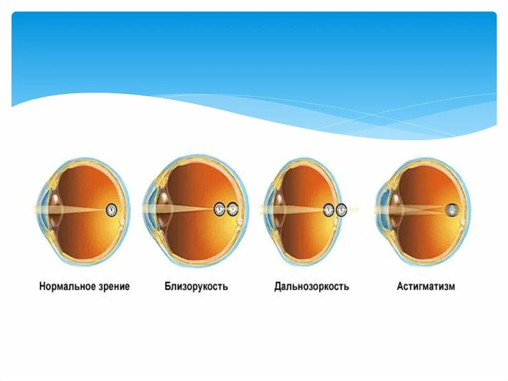 Что такое сложный миопический астигматизм. Миопия гиперметропия астигматизм. Миопия дальнозоркость астигматизм. Миопия гиперметропия астигматизм пресбиопия. Нормальное зрение дальнозоркость близорукость.