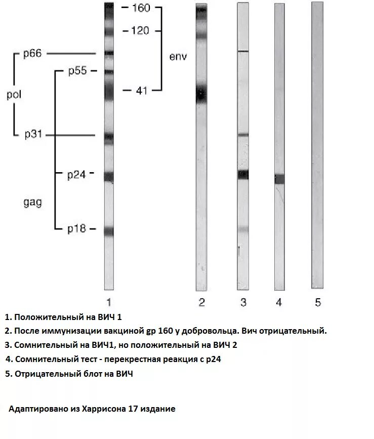 Иммуноблоттинг интерпретация результатов. Иммуноблот ВИЧ. ВИЧ инфекция иммуноблот. Положительный иммуноблот на ВИЧ.