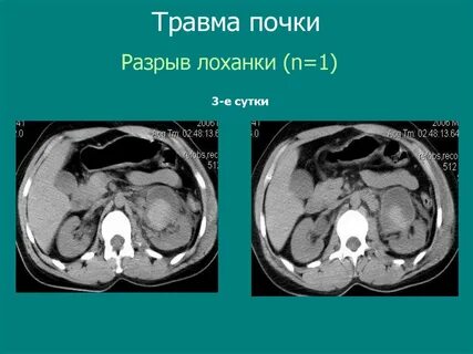 Разрыв почки