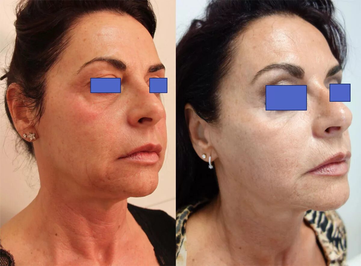 Смас ультраформер. Ультраформер аппарат фото до и после. Ультраформер лифтинг. Ультраформер отзывы фото. Smas лифтинг ultraformer.