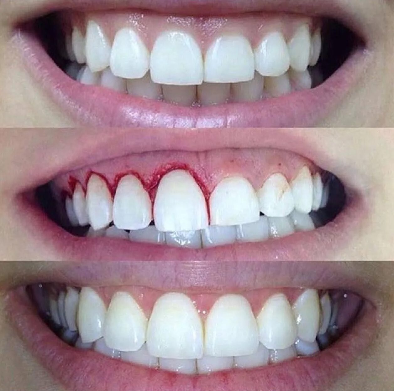 Ровные зубы. Красивая форма зубов. Идеальные зубы. Изменение формы зубов