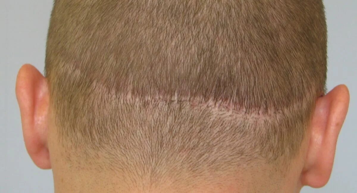 Трансплантация волос с затылка. Шрамы после пересадки волос.