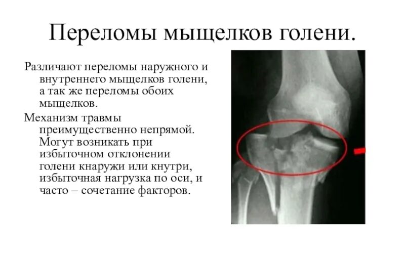 Перелом внутреннего мыщелка большеберцовой кости рентген. Компрессионный перелом наружного мыщелка большеберцовой кости. Оскольчатый перелом мыщелка берцовой кости. Импрессионный перелом внутреннего мыщелка бедренной кости.