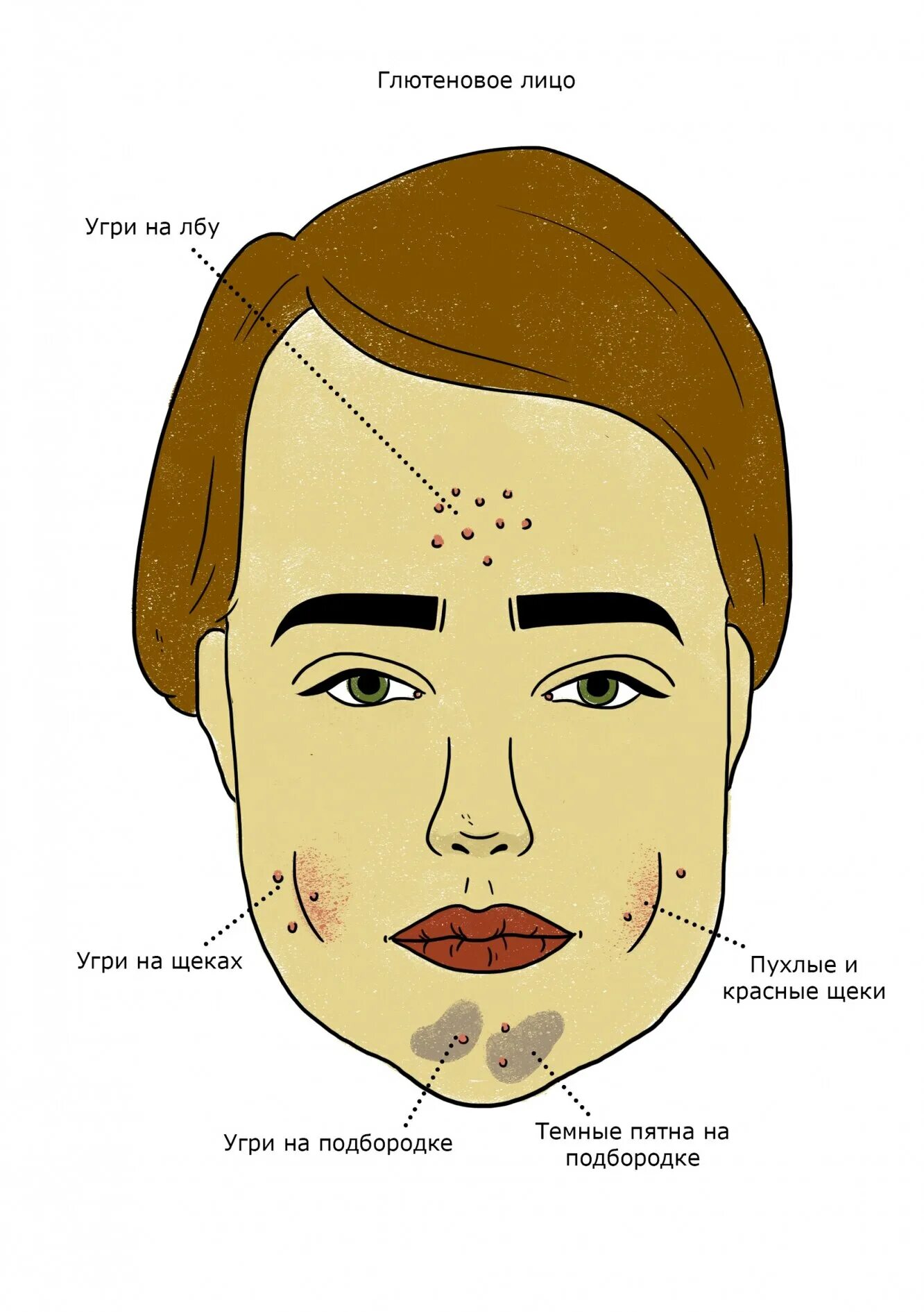 Сахарное лицо и винное. Винное лицо. Сахарная кожа. Как выглядит сахарное лицо. Молочное лицо глютеновое лицо винное лицо и сахарное лицо.