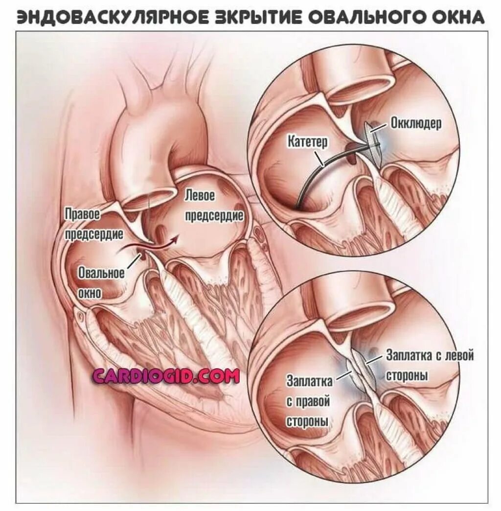 Где находится овальное окно. Открытое овальное окно. Незаращённое овальное окно. Функционирующее овальное окно. Открытое овальное окно в сердце.