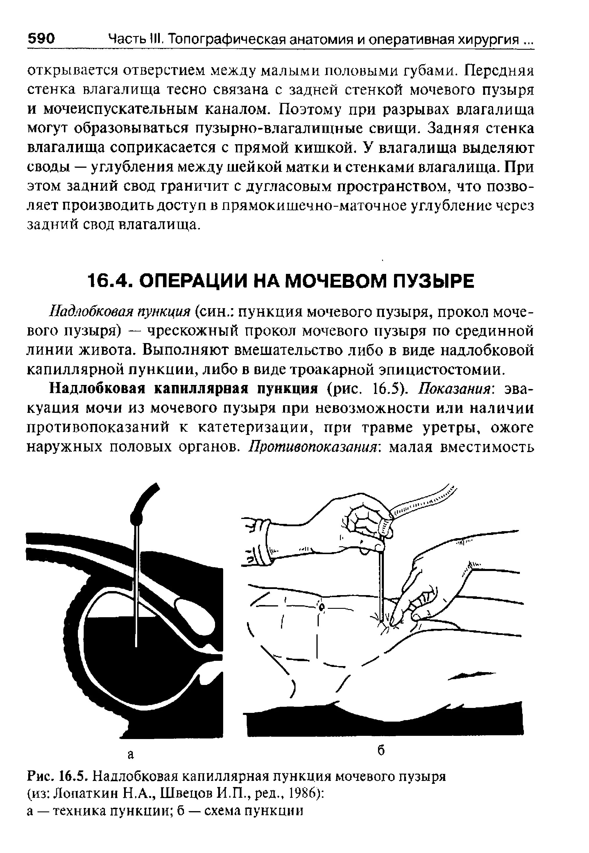 Продемонстрируйте технику надлобковой пункции мочевого пузыря.. Капиллярная пункция мочевого пузыря техника. Надлобковая капиллярная пункция мочевого пузыря. Цистостома мочевого пузыря катетер.