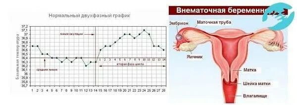 Может ли на ранних сроках беременности быть температура 37,7. Какая температура тела должна быть у беременной на раннем. БТ при внематочной беременности. БТ при беременности на ранних внематочной беременности на ранних. Месячные после удаления трубы