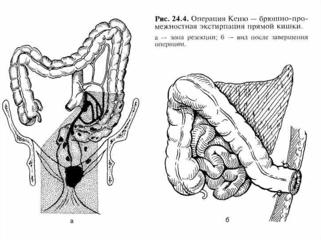 Брюшно-промежностная экстирпация прямой кишки по Кеню Майлсу. Операция резекции Толстого кишечника. Промежностная резекцию прямой кишки это. Операции через прямую кишку