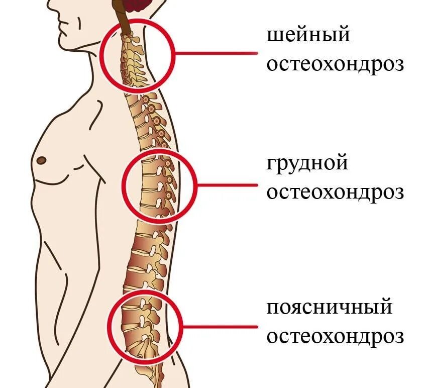 Остеохондроз отдела позвоночника. Сипогиы остеохондроза. Шейно-грудной остеохондроз. Остеохондроз шейных позвонков. Шейный хондроз симптомы.