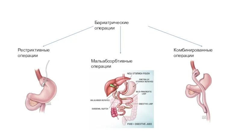 Реконструктивная бариатрическая операция 1 категории сложности. Бариатрия операция желудка что это. Бариатрическая операция на желудке. Бариатрическая операция типы.