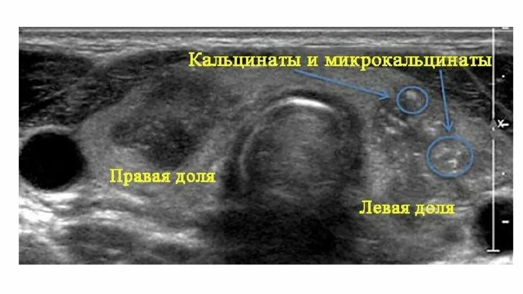 Кальцинат в печени на узи. Микрокальцинаты в почках на УЗИ. Кальцинированный узел щитовидной железы УЗИ. Кальцинаты щитовидной железы на УЗИ. Кальцинат молочной железы на УЗИ.