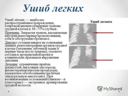 Ушиб легких