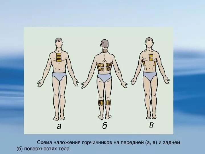 Точечный массаж для отхождения мокроты. Горчичники при кашле зоны. Перцовый пластырь схема наклеивания. Горчичники и перцовый пластырь. Перцовый пластырь на спину от кашля.