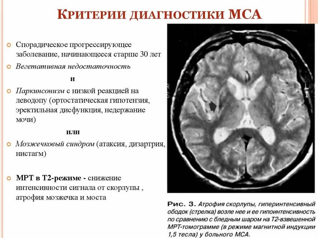 Атрофия головного мозга 1. Мультисистемная атрофия мрт. Множественная системная атрофия. Атрофия головного мозга мрт. Мультисистемная атрофия головного мозга.