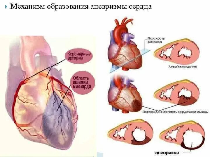 Острая аневризма левого желудочка при инфаркте миокарда. Левожелудочковая аневризма. Подострая аневризма сердца. Хроническая аневризма левого желудочка макропрепарат. Аневризма сердца что это такое симптомы