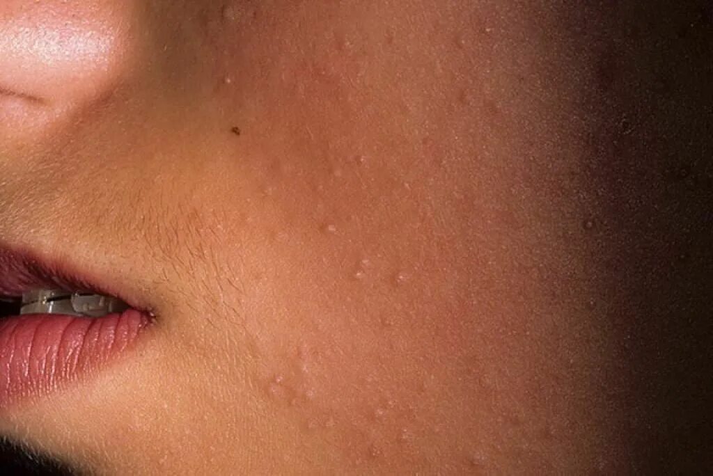 Постакне: что это, причины появления и лечение - Fillers-Shop.ru