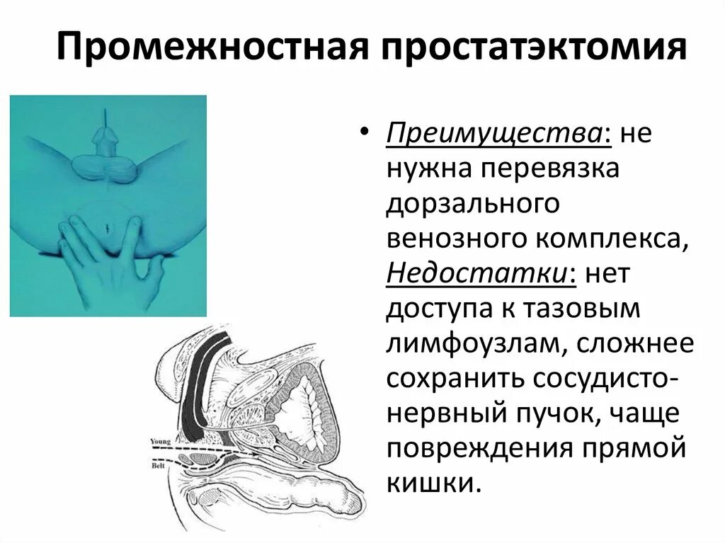 Удаление простаты какие последствия. Промежностный доступ к предстательной железе. промежностная аденомэктомия простаты. радикальная промежностная простатэктомия что это. промежностная простатэктомия техника.