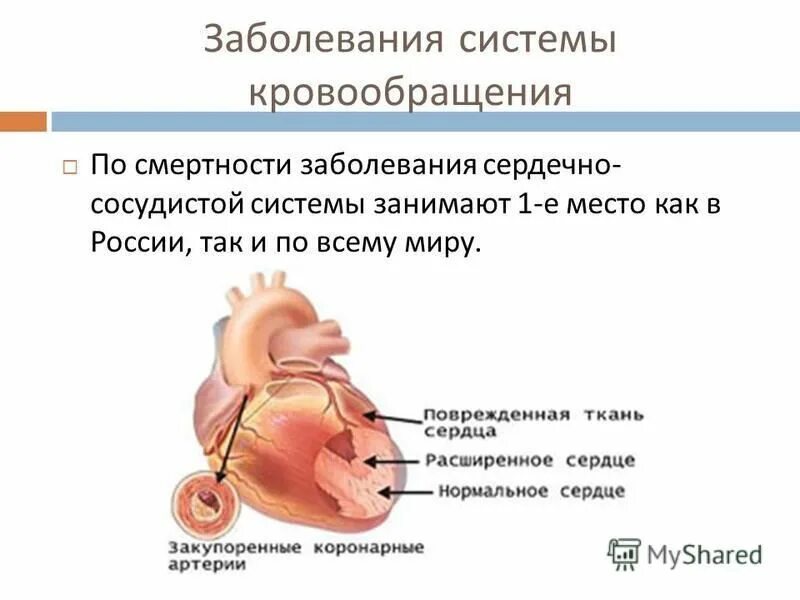 Причины болезней системы кровообращения