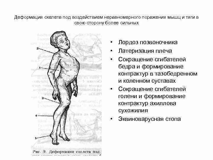 Виды деформаций скелета. Нарушение развития скелета. Деформации скелета у детей. Женщина с нарушением в развитии скелета