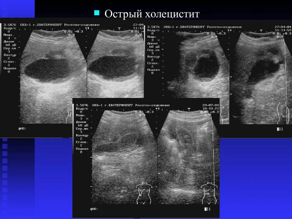 Отек желчного пузыря. УЗИ желчного пузыря острый холецистит. Перивезикальный выпот желчного пузыря. Острый холецистит УЗИ картина.