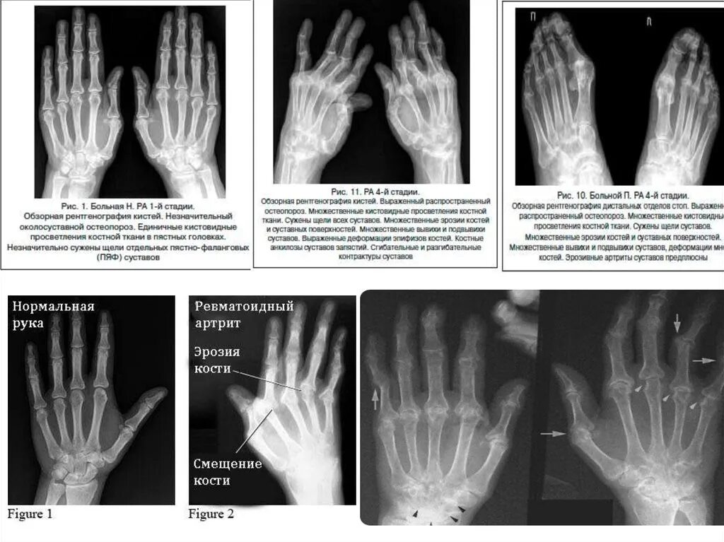 Ранняя стадия ревматоидного артрита. 28 Суставов ревматоидный артрит. Паукообразная кисть ревматоидный артрит. Ревматоидный артрит кисти рентген. Ревматоидный артрит рентген протокол.
