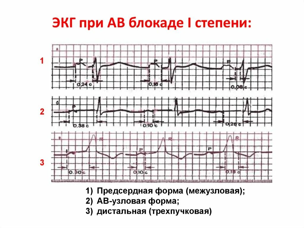 Блокада на первом. АВ блокада 1 степени Узловая форма на ЭКГ. АВ блокада на ЭКГ. АВ блокада на ЭКГ расшифровка. АВ блокада 3 степени на ЭКГ.