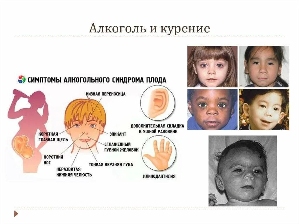 Алкогольный синдром у взрослых. Фетальный алкогольный синдром. Фетальный алкогольный синдром патогенез. Симптомы фетального алкогольного синдрома. Алкогольный синдром плода (фетальный алкогольный синдром)..