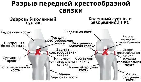 Симптомы крестообразной связки коленного сустава. Крестовидная связка коленного сустава. Крестообразная связка коленного сустава. Отрыв крестообразных связок коленного сустава рентген. Рентген крестообразной связки коленного сустава.