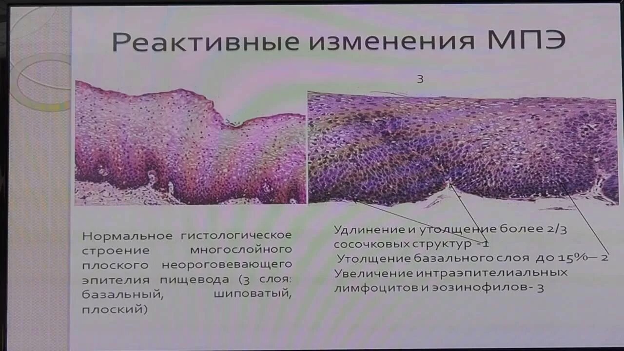 Воспаление с реактивными изменениями клеток. Многослойный плоский эпителий с реактивными изменениями. Реактивные изменения эпителия что это такое. Реактивные изменения части клеток. МПЭ С реактивными изменениями.