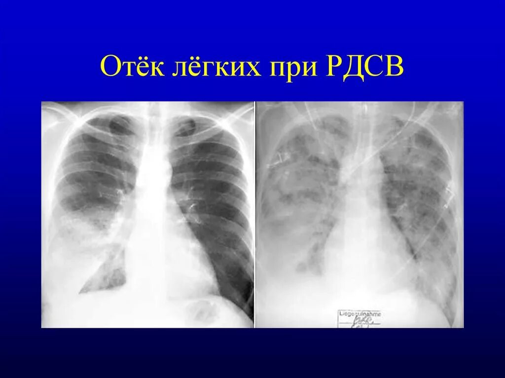 Кашель отек легких. Отек легких рентген. Отечный синдром легких.